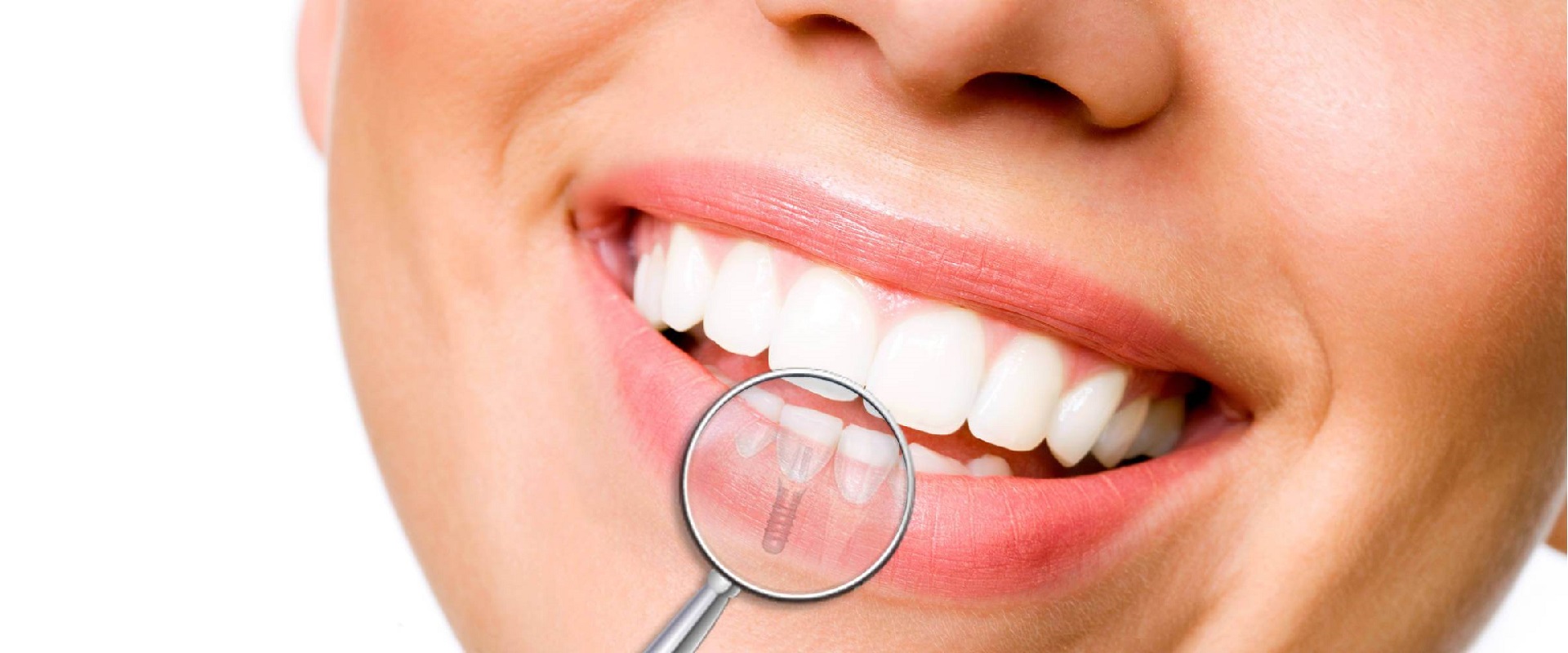 Implantologia dentale? Niente di più semplice!
